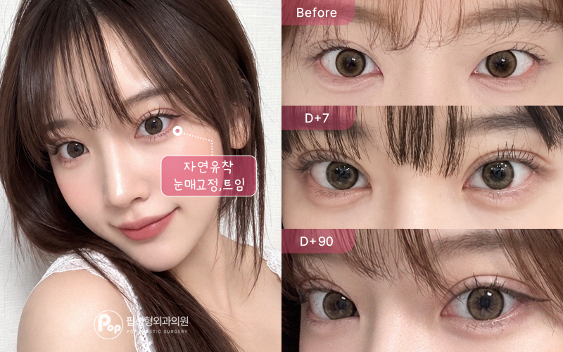 눈매교정 수술 전과 3개월 후 비교 두 번째 사례