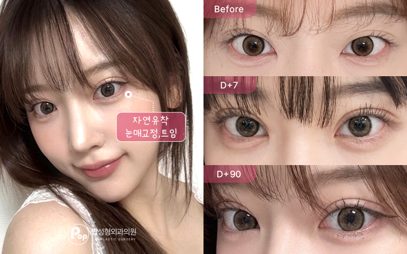 12홀 자연유착 눈매교정 윗트임 눈밑지방재배치 3개월차 경과 이미지