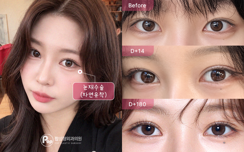 눈재수술 12홀 자연유착 윗트임 앞트임 6개월차 경과 이미지