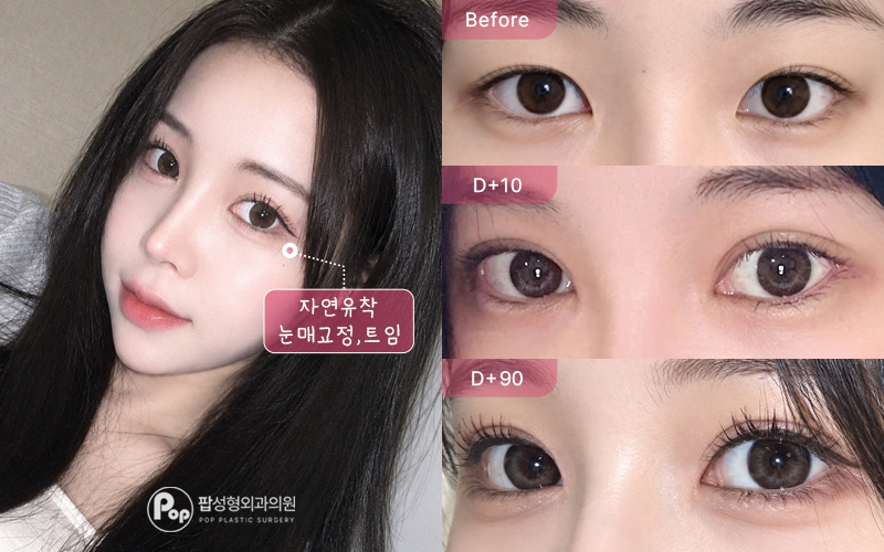 눈도 짧은데 졸려 보인다는 말까지 들어요. 전후 비교