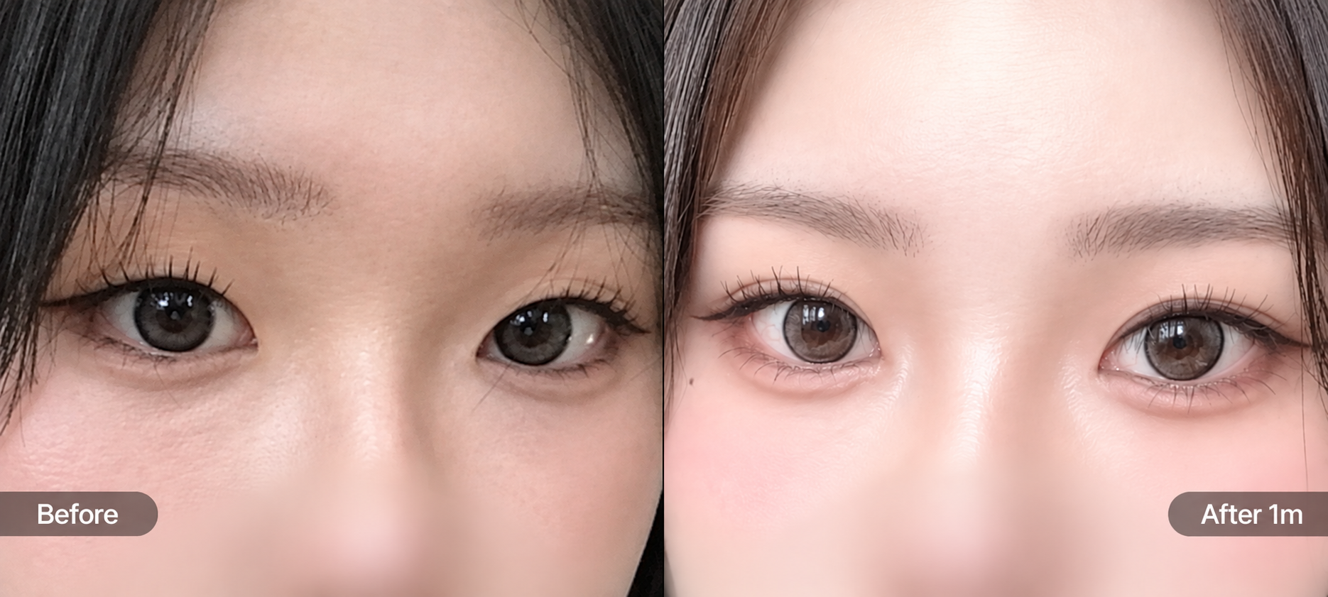 자연유착 쌍꺼풀 주름 졸려 보이는 눈 1개월차 경과 이미지