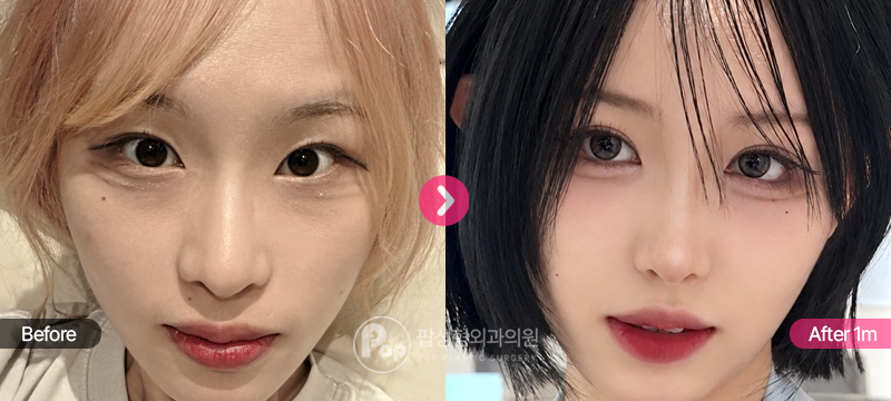 자연유착 눈매교정 윗트임 뒤밑트임 눈밑지방재배치 1개월차 경과 이미지