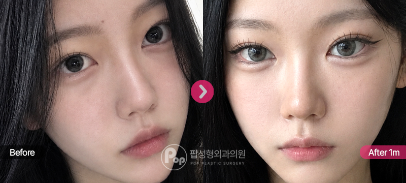 자연유착 눈재수술 1개월차 경과 이미지