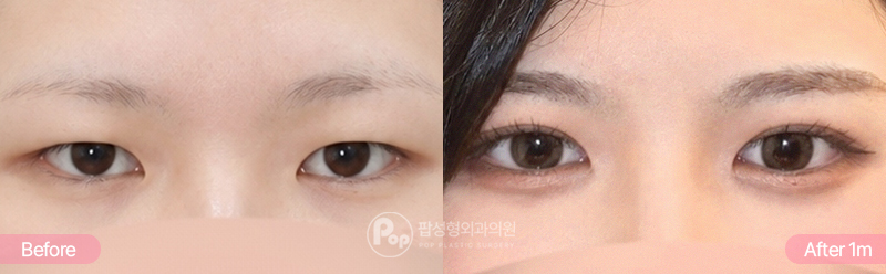 인아웃라인 쌍꺼풀 수술 1개월차 경과 이미지