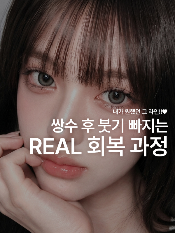 쌍꺼풀 수술 후 붓기가 빠지며 라인이 자리 잡는 과정