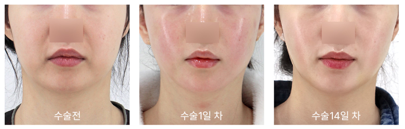 미니거상 수술 1일차와 14일차 회복 비교 두 번째 사례