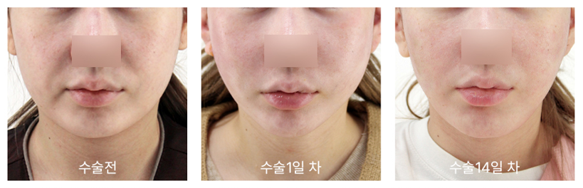 미니거상 수술 1일차와 14일차 회복 비교
