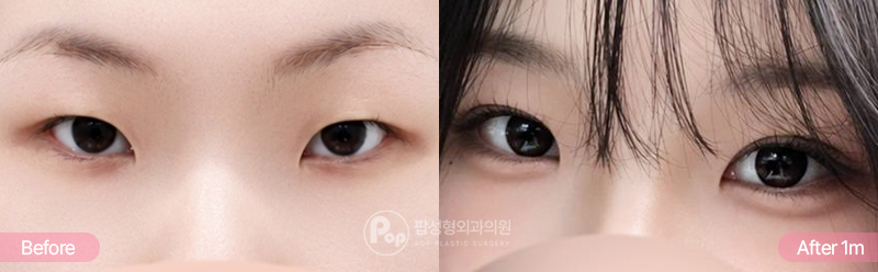 무쌍 자연유착 눈매교정 앞트임 윗트임 1개월차 경과 이미지