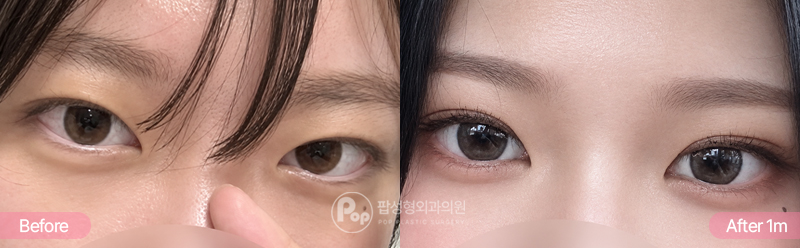 12홀 자연유착 윗트임 눈매교정 1개월차 경과 이미지