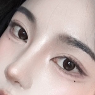 넓은 콧볼과 낮은 코끝을 함께 정리한 경우 AFTER · 2 WEEKS