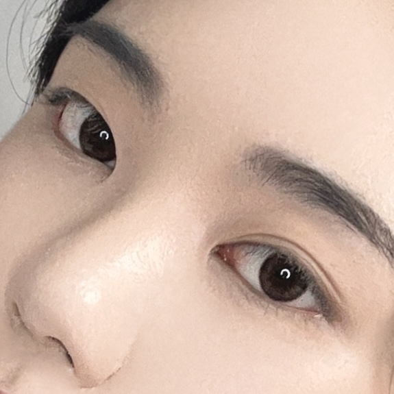 넓은 콧볼과 낮은 코끝을 함께 정리한 경우 전