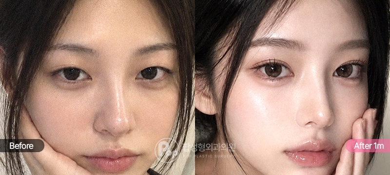 무쌍 자연유착 눈매교정 윗트임 1개월차 경과 이미지