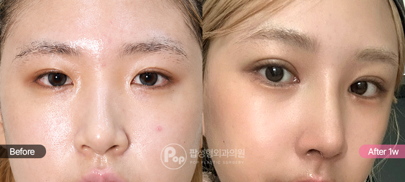눈재수술 코성형 1주차 정면 경과 이미지