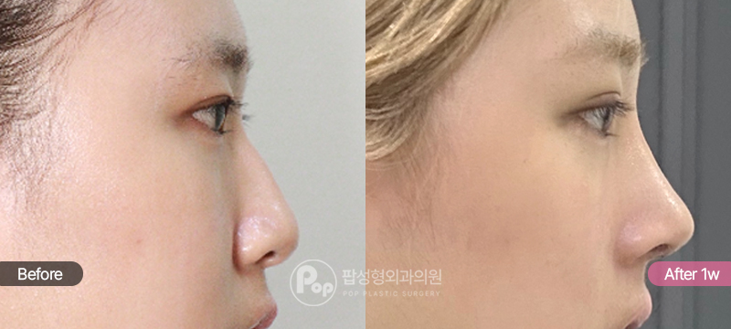 눈재수술 코성형 1주차 측면 경과 이미지