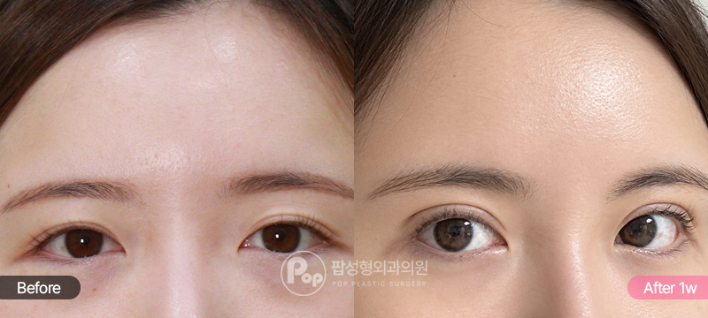 이마실리프팅 눈재수술 1주차 경과 이미지