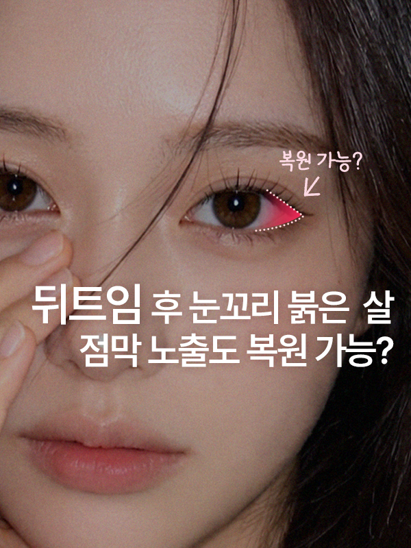 뒤트임 후 눈꼬리에 드러난 붉은 점막