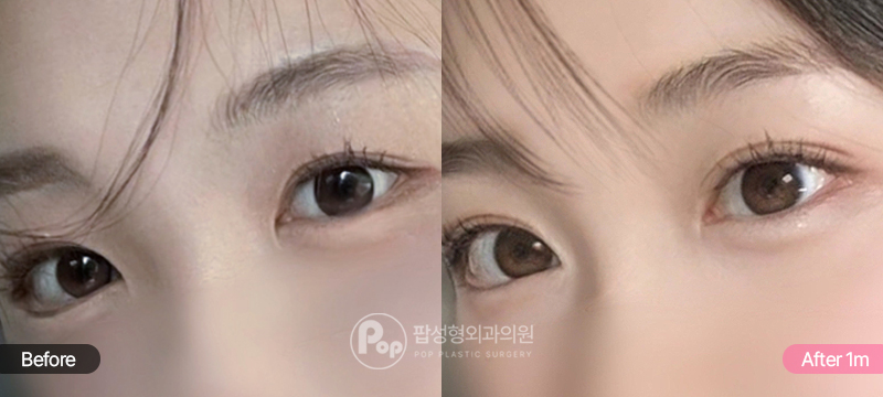 기존 쌍꺼풀을 세미아웃 라인으로 바꾼 눈재수술 전후 1개월 비교