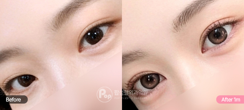 무쌍 눈에 세미아웃 쌍꺼풀 라인을 만든 수술 전후 1개월 비교