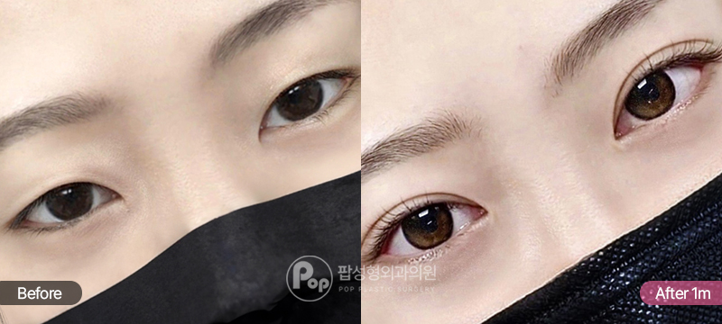 자연유착 눈매교정 앞윗트임 뒤밑트임 인아웃라인 1개월차 경과 이미지