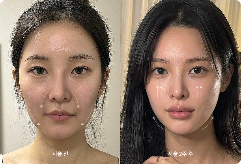 실리프팅 중안부 축소 효과 시술 전과 2주 후 비교