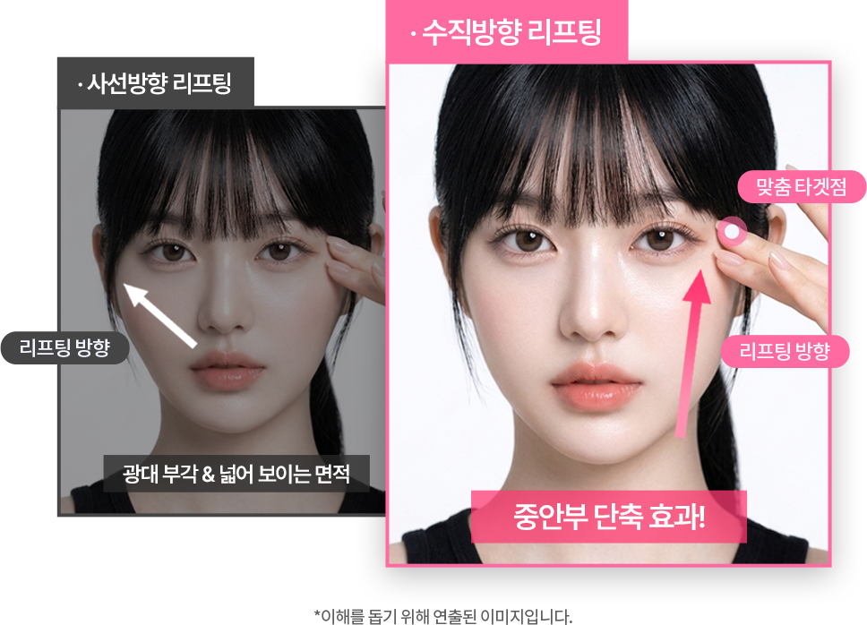 팝성형외과 중안부 축소 효과를 위한 수직 방향 리프팅 설명