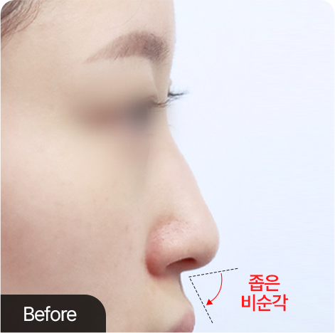 비순각 교정 · 얼굴 입체감 상승 전