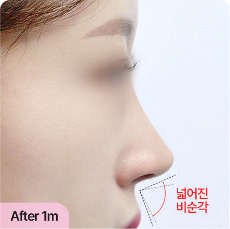 비순각 교정 · 얼굴 입체감 상승 AFTER · 1 MONTH