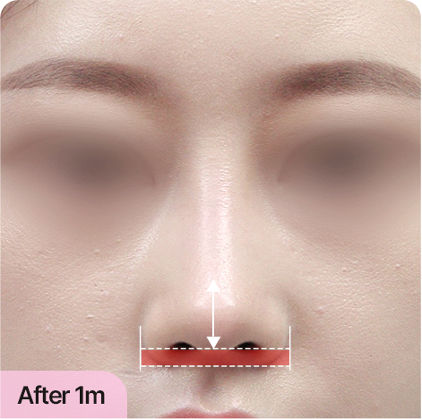 비주 길이 조절 · 중안부가 짧아 보이는 효과 AFTER · 1 MONTH
