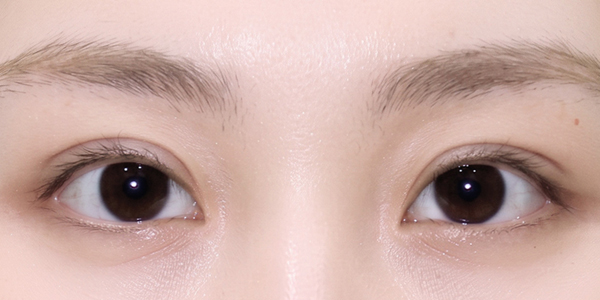자연유착 + 윗트임 + 앞트임 + 눈매교정 · 2개월 후 AFTER · 2 MONTHS
