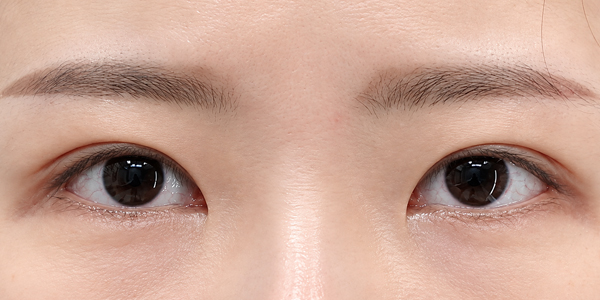 눈썹하거상 + 자연유착 + 눈매교정 · 1개월 후 AFTER · 1 MONTH
