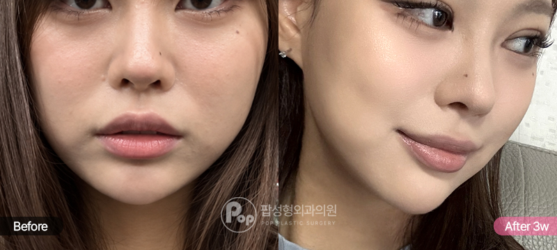 이중턱 지방흡입과 근육묶기 전과 3주 후 정면 비교
