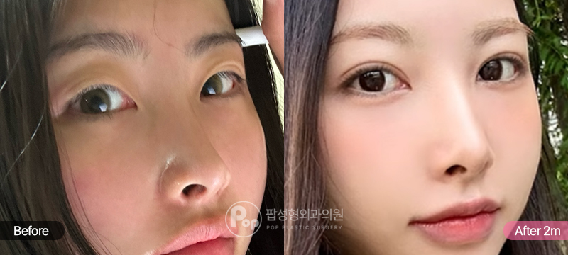 자연유착 눈매교정 트임 세미아웃라인 2개월차 경과 이미지