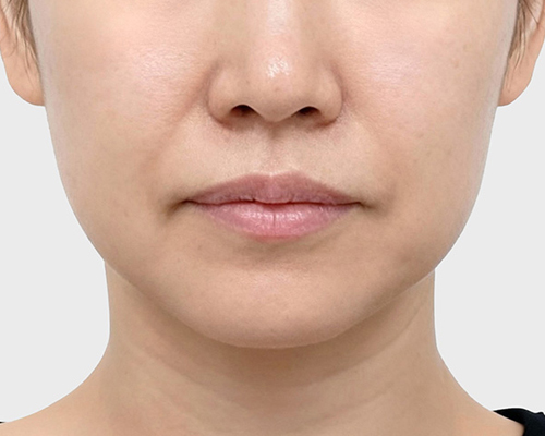 30대 · 처지기 시작한 볼과 팔자 전