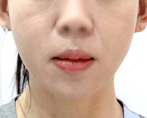 40대 · 깊어진 팔자와 내려온 볼살 전