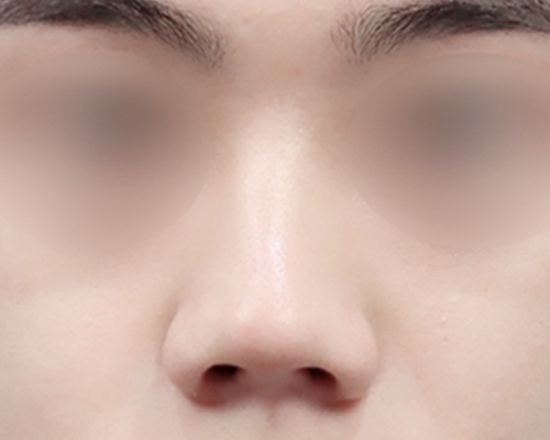 남성 복코 · 정면 전