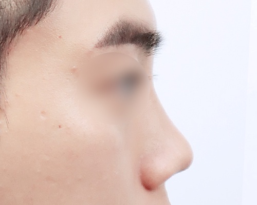 남성 복코 · 측면 전