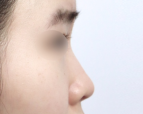 여성 복코 · 측면 전