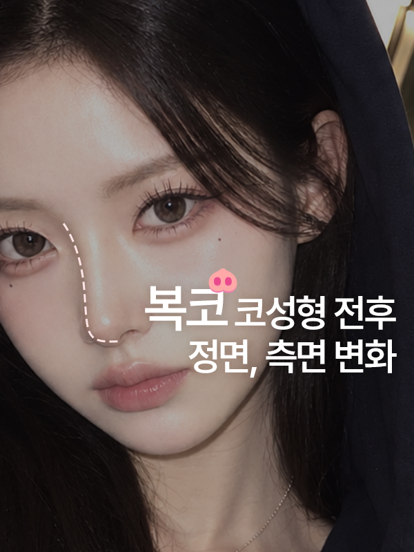 복코 코성형 전후 코끝 변화
