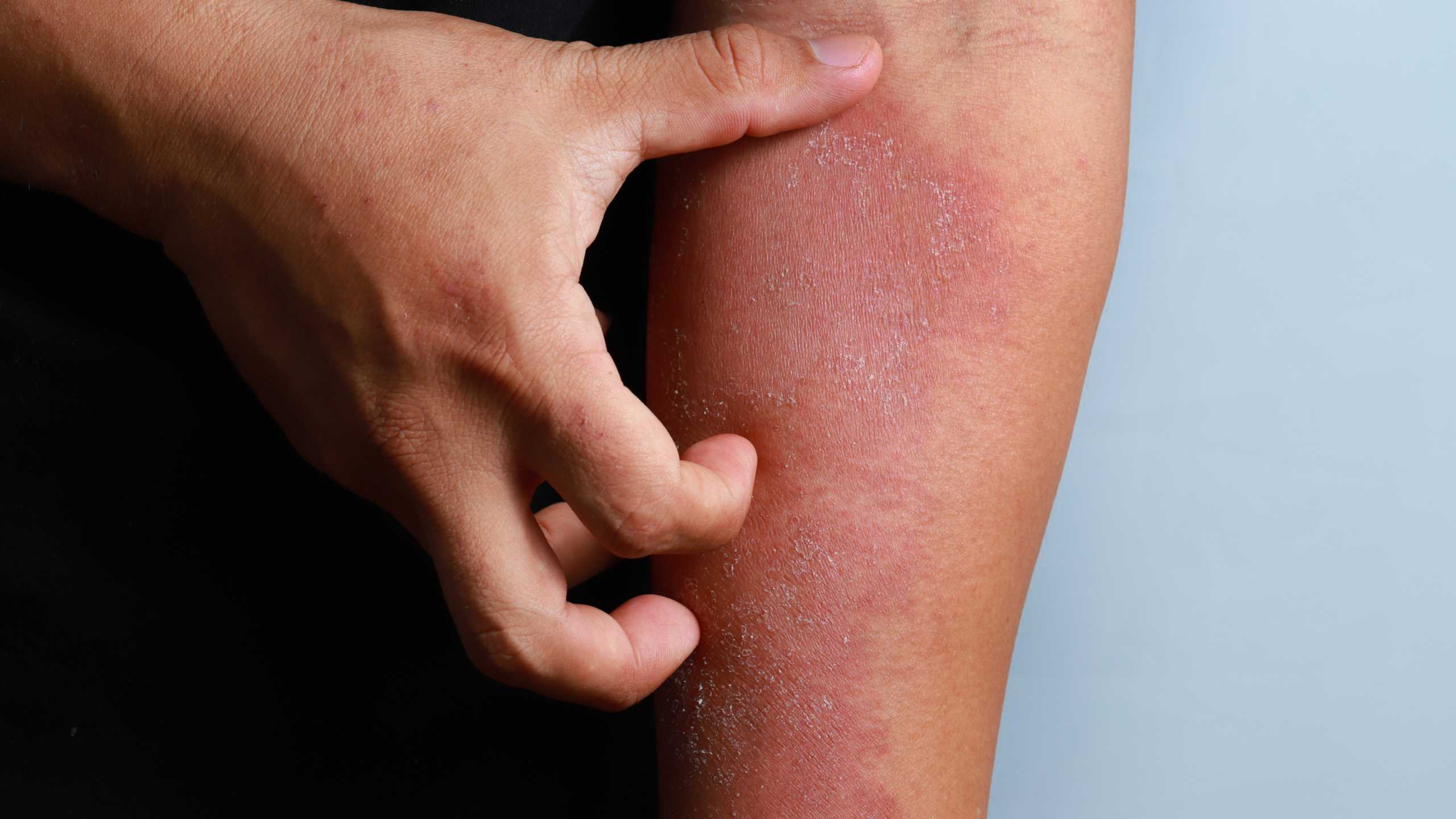 Understanding and managing atopic dermatitis