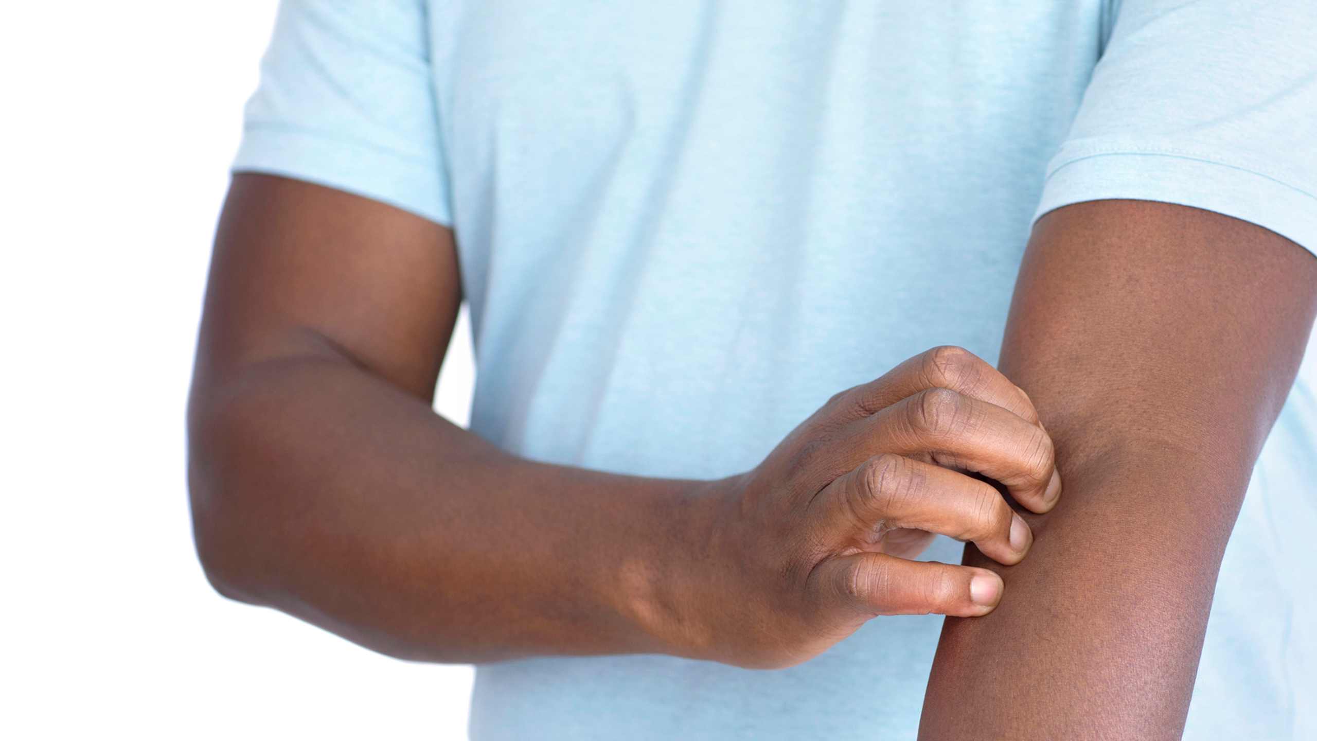 Your guide to managing and treating stress related eczema