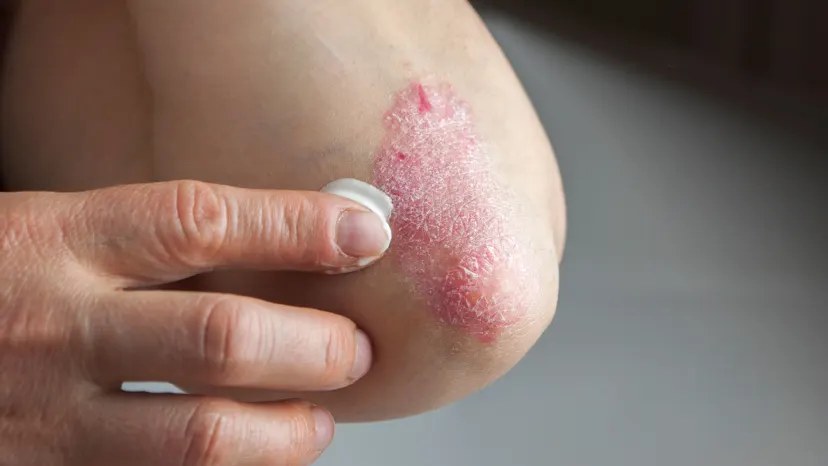 closeup view of psoriasis on a person's elbow