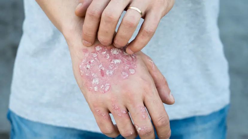 closeup view of red and scaly psoriasis patches on a person's hand