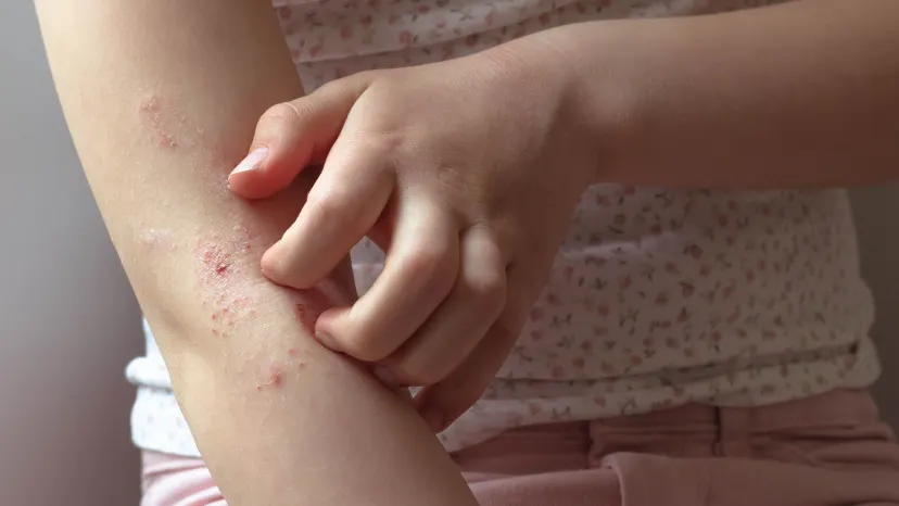 child scratching eczema flare up on skin around elbow
