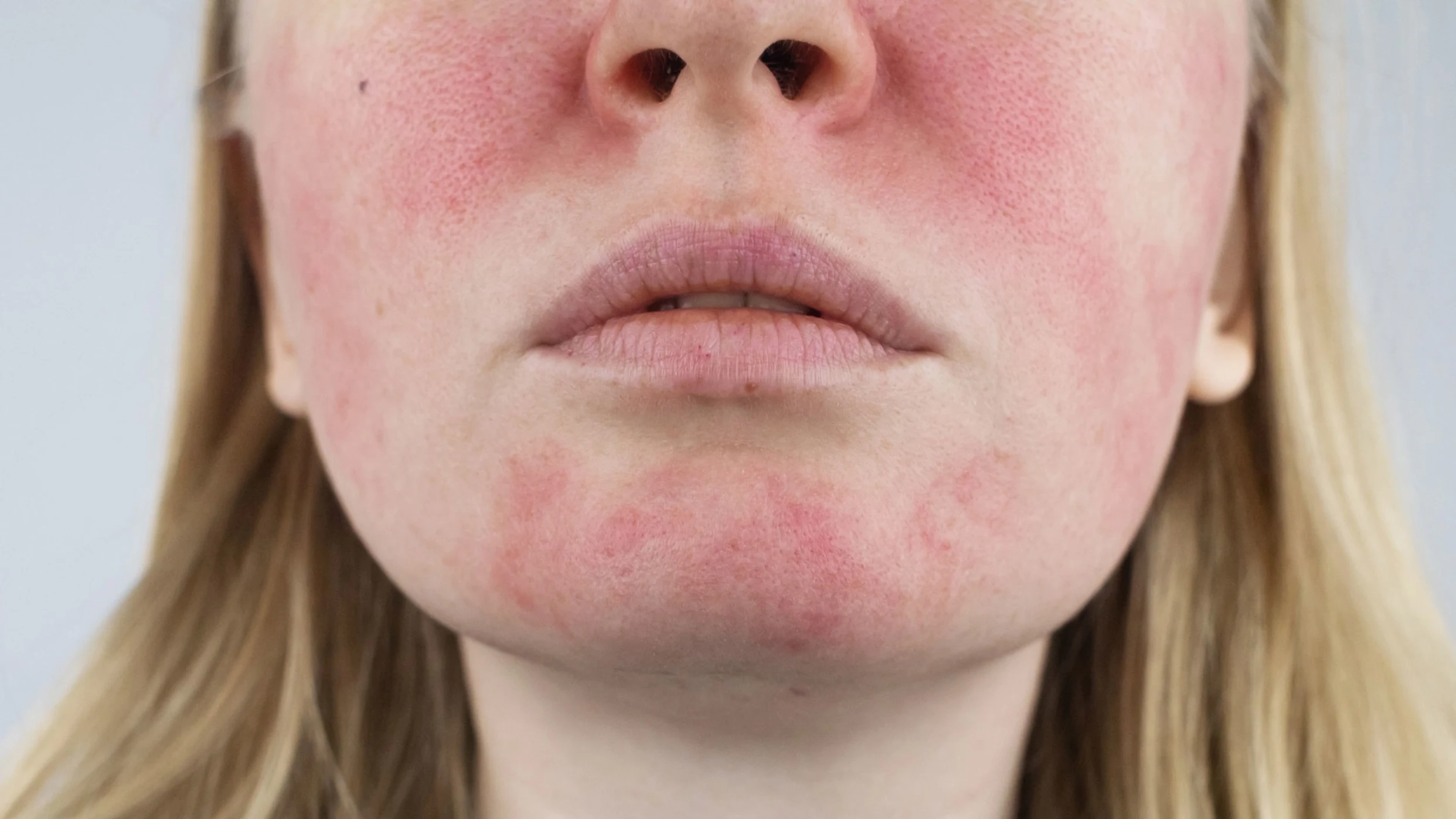 Rosacea: Signs, Symptoms, and Complications