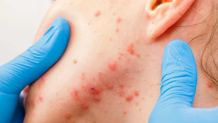Dermatologist examining the fae of a patient with severe acne