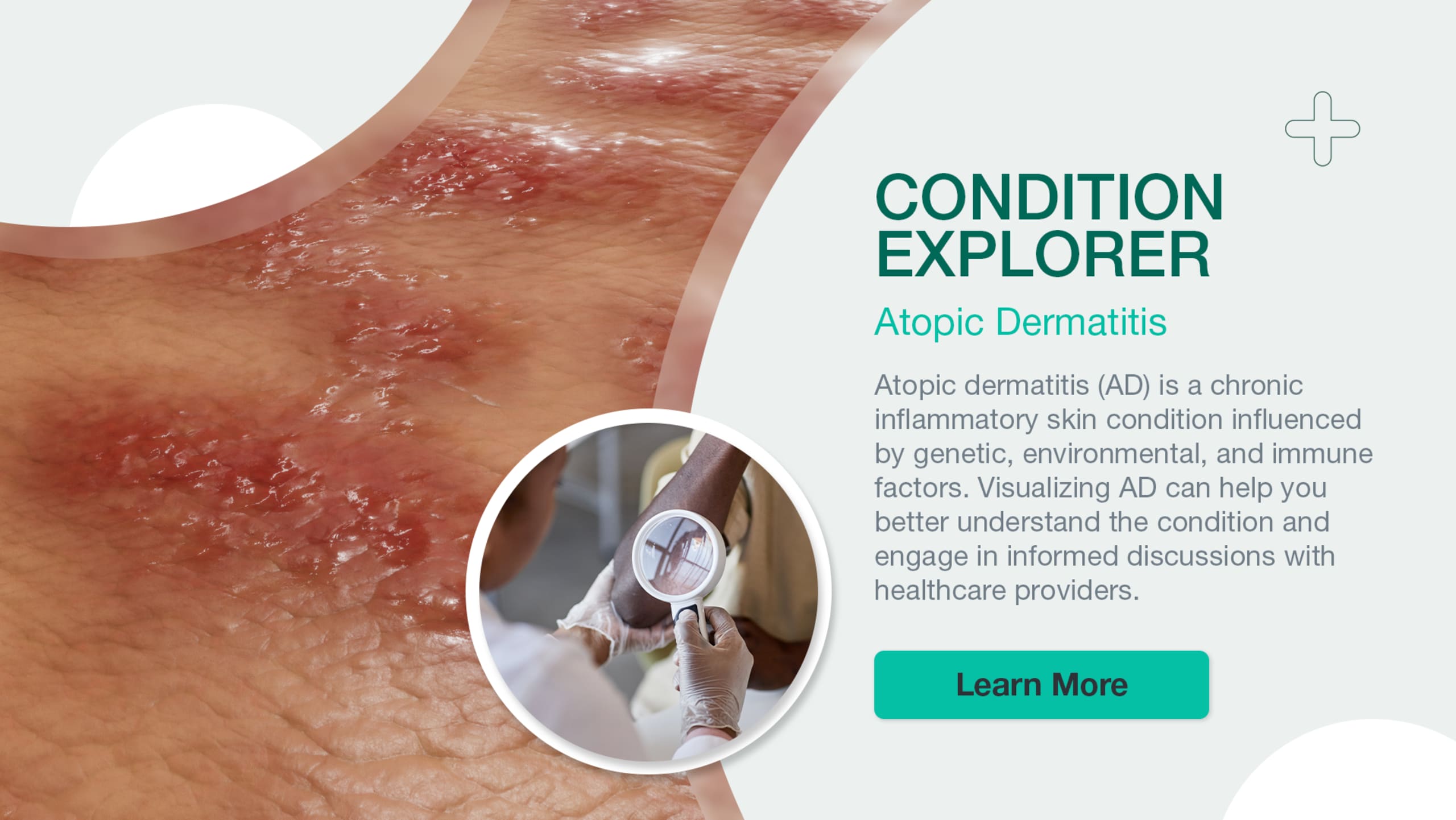 Condition Explorer: Atopic Dermatitis