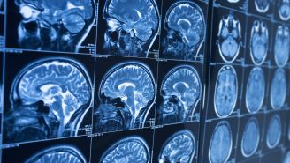 Learn the basics of Alzheimer's disease