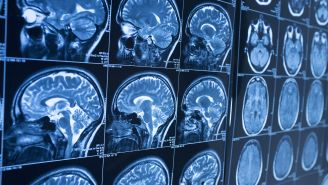 Parkinson's disease, explained