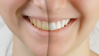 Teeth whitening tips and secrets