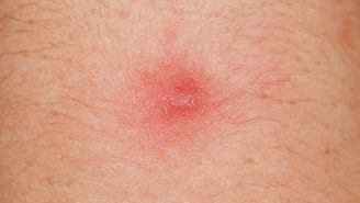 What’s on my skin? 8 common bumps, lumps, and growths
